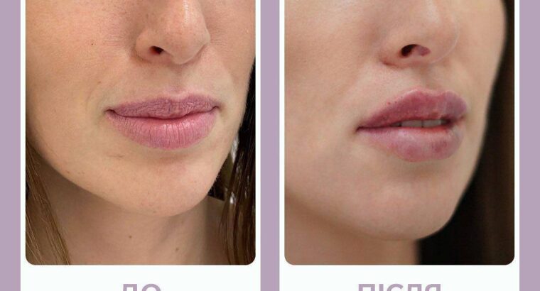 💥ЗНИЖКА -10% на процедуру збiльшення губ