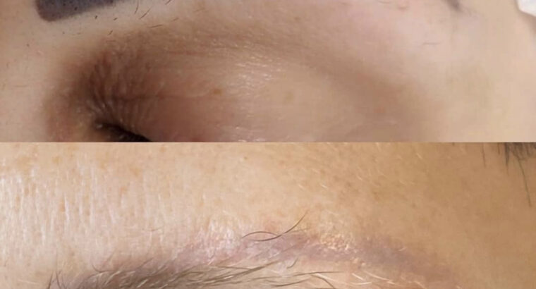 Видалення тату та татуажу