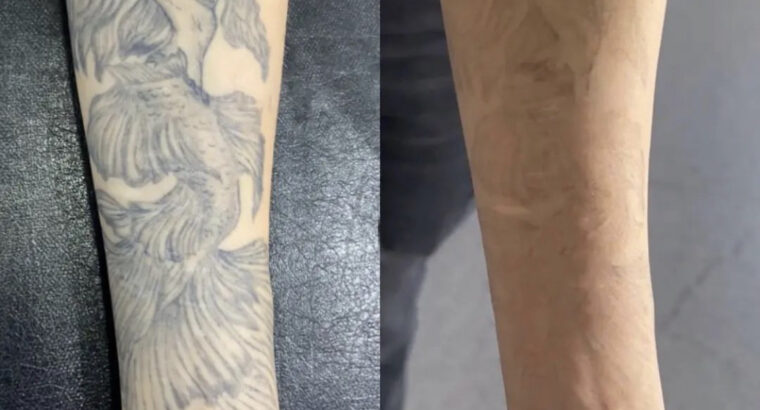 Видалення тату та татуажу